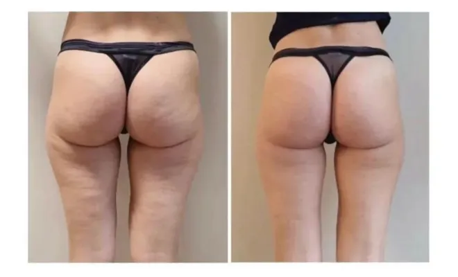 Où faire un traitement contre la cellulite à Antibes ?, Antibes, BA Centre Esthétique