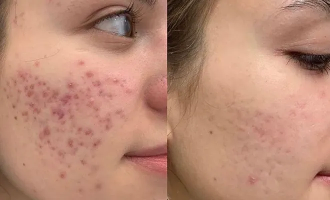 Centre esthétique médical Antibes – Protocoles personnalisés pour acné et peau à imperfection, Antibes, BA Centre Esthétique