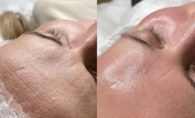 Un avant après procédure, Antibes, BA Centre Esthétique