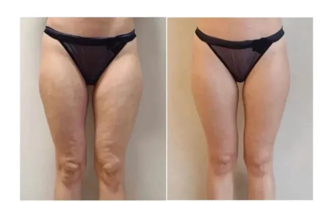 Séance de contouring corporel réalisée avec la technologie EndyMed 3DEEP à Antibes. Ce traitement par radiofréquence permet de raffermir la peau, réduire la cellulite et redessiner la silhouette de manière efficace et non invasive.