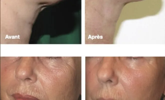 Endymed 3DEEP à Antibes : raffermi et lisse le visage, Antibes, BA Centre Esthétique