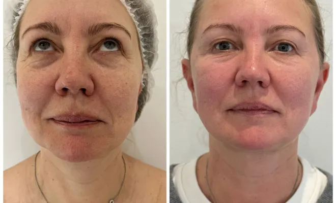 Endymed Intensif – Traitement Anti-Âge et Raffermissant à Antibes, Antibes, BA Centre Esthétique