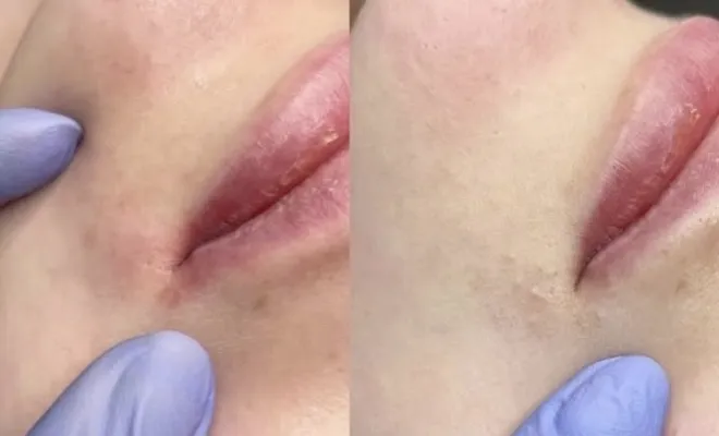 Nettoyage de peau en profondeur - Antibes, Antibes, BA Centre Esthétique