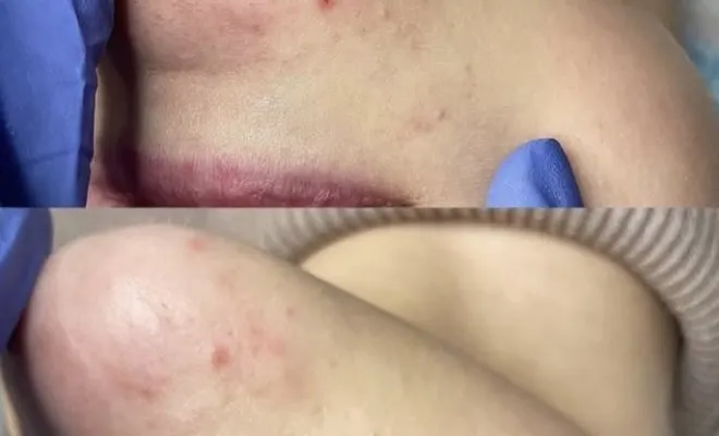 Nettoyage de peau en profondeur - Antibes, Antibes, BA Centre Esthétique