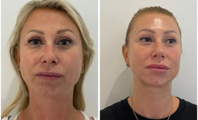 Potocole Facial Personnalisé – Radiofréquence, Peeling Chimique & Soins Avancés, Antibes, BA Centre Esthétique
